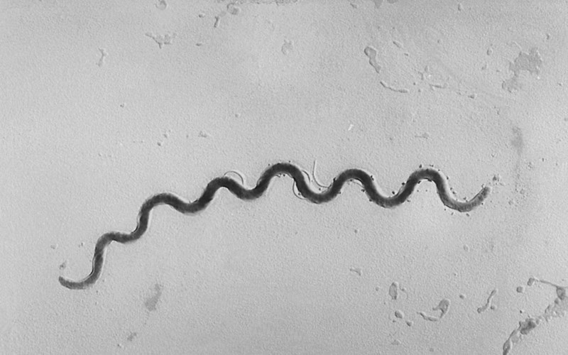 Syphilis cases in U.S. newborns skyrocketing