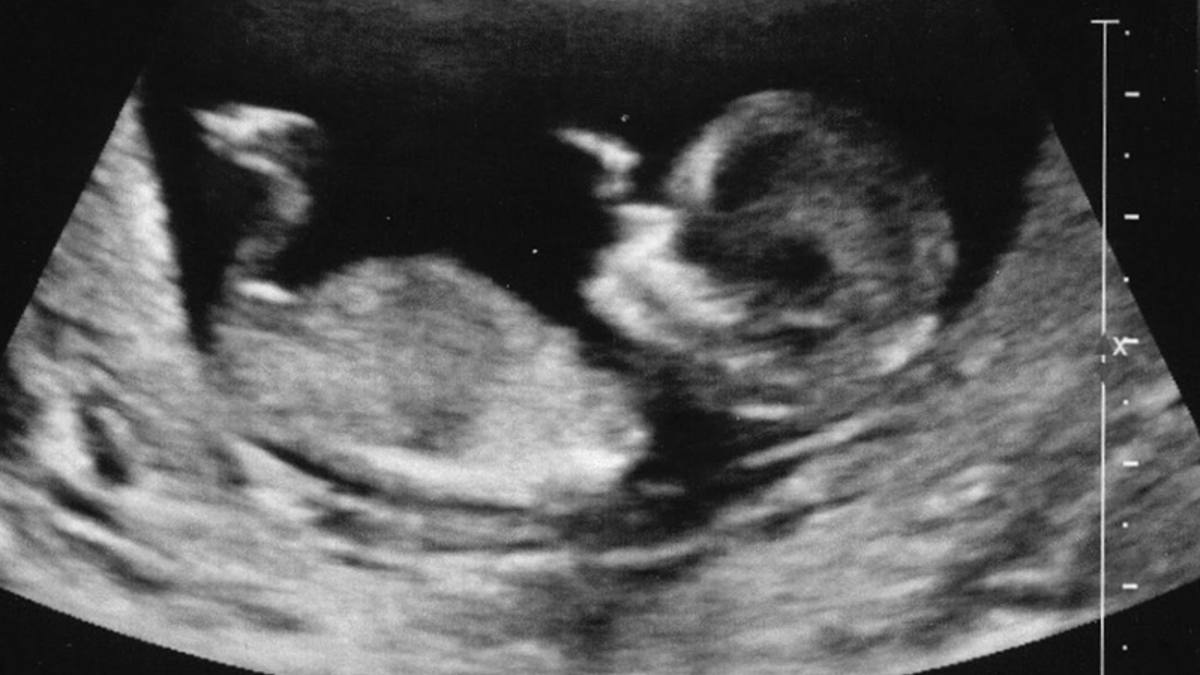 Abortion-supporting doctors 'building bridges' but ban 'baby' - Vimarsana News