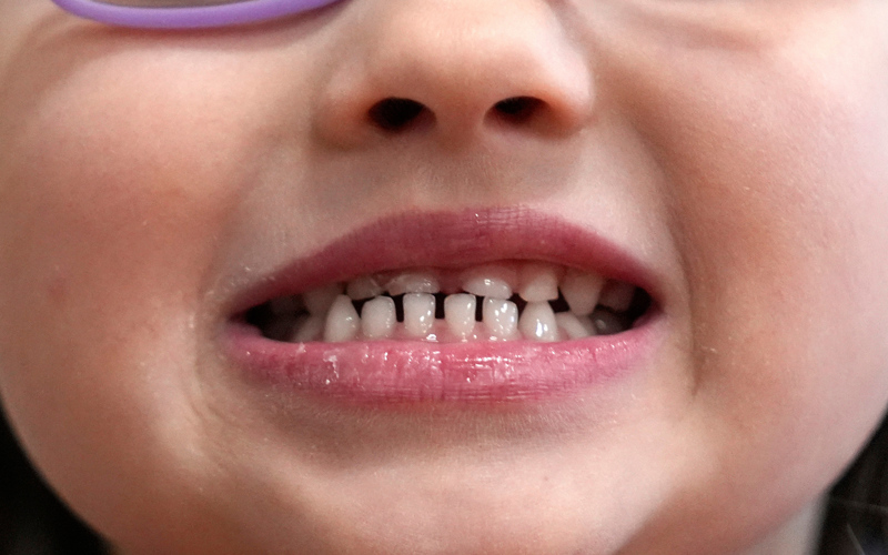 FDA restricts use of kids' fluoride supplements citing emerging health risks